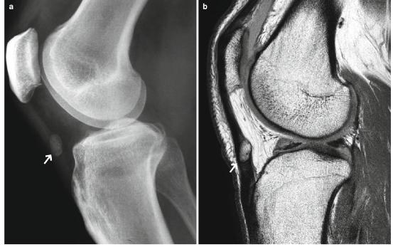 髕腱炎成為醫(yī)學(xué)焦點，從幕后走向舞臺中央的最新進(jìn)展