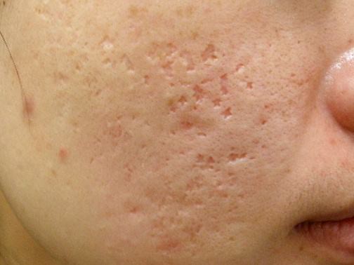 最新痘坑撫平神器，科技重塑肌膚之美，自信生活從此開始