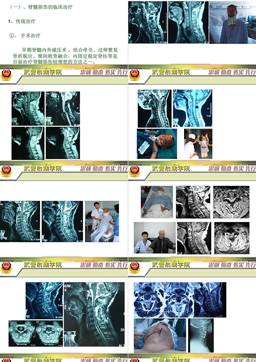 2023年脊髓損傷研究新進展，里程碑式的突破與日常奇妙變化