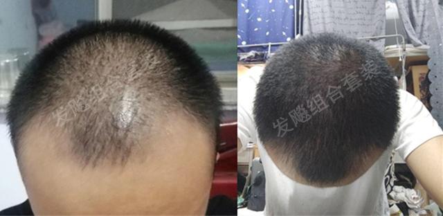 治愈脫發(fā)最新重大突破，重塑自信，希望之光再現(xiàn)